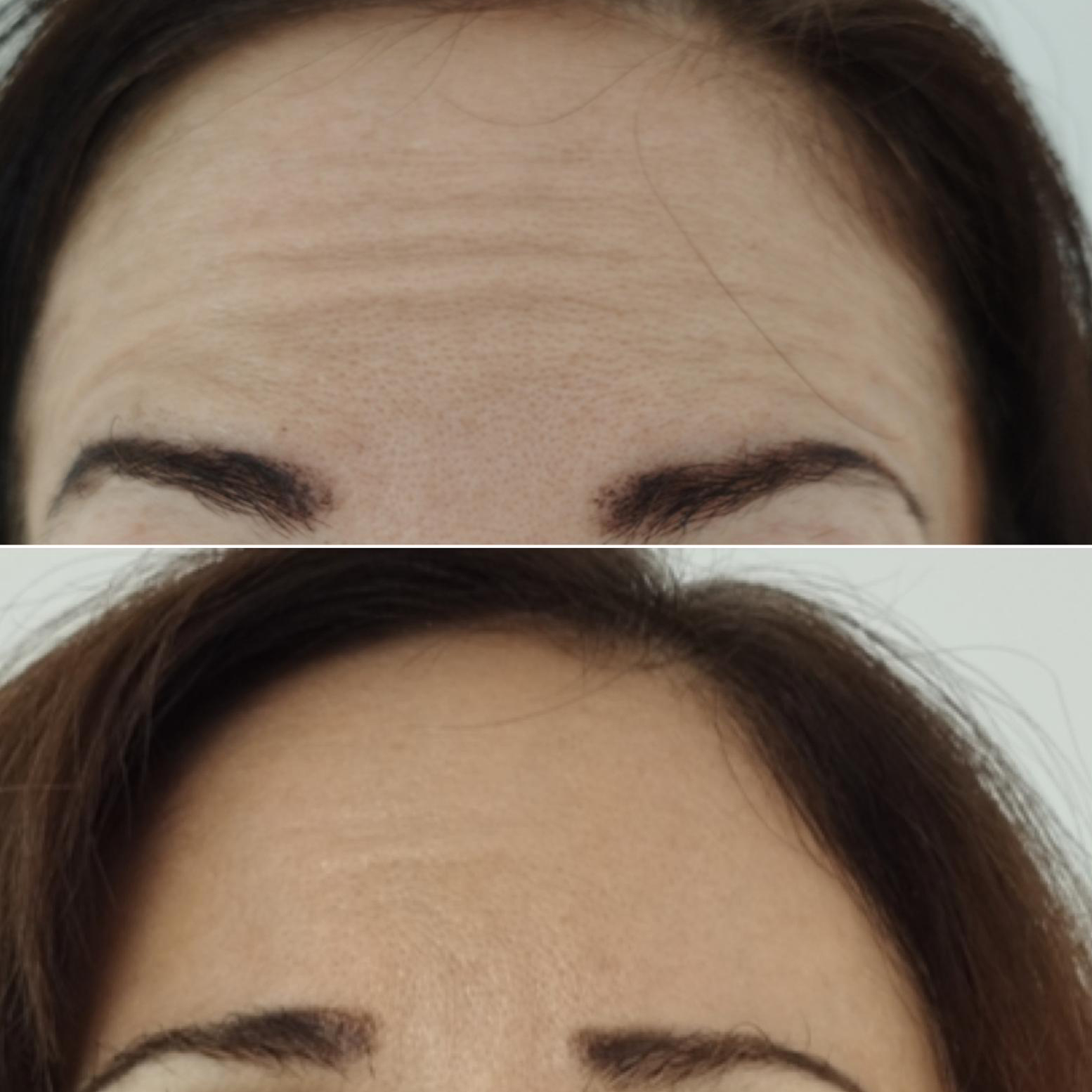 botox viso