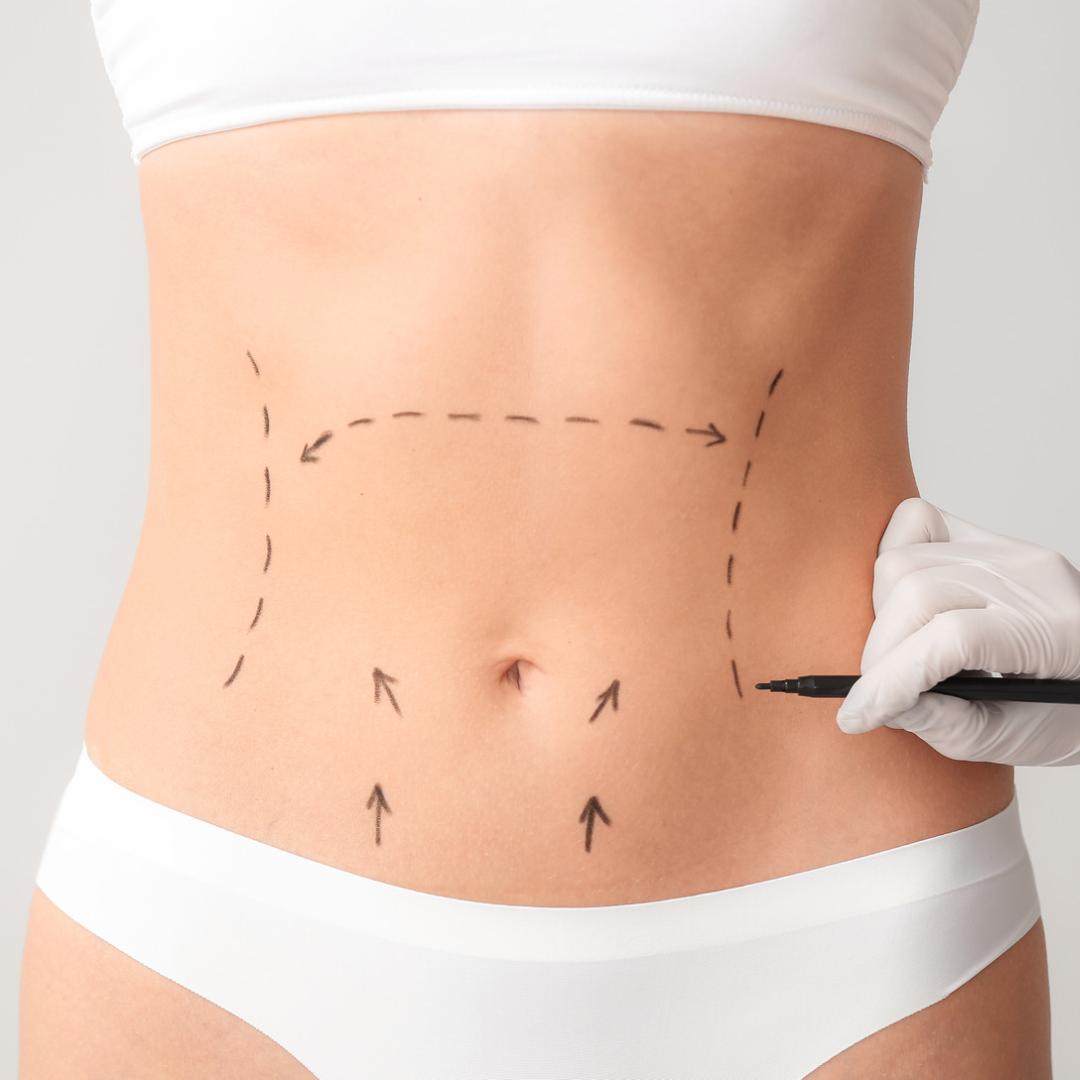 Liposcultura non chirurgica