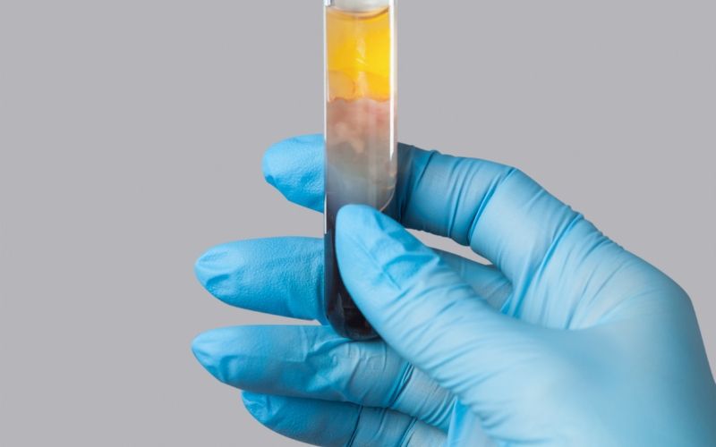 PRP zona perioculare per ridurre occhiaie scure e migliorare la luminosità dello sguardo