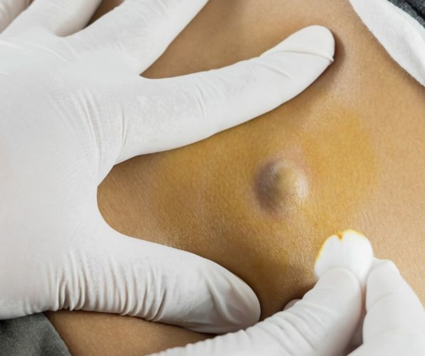 Procedura dermatologica per la rimozione di cisti sebacea con micro-incisione minimamente invasiva