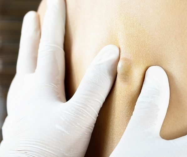 Cisti sebacea infiammata su schiena prima del trattamento dermatologico