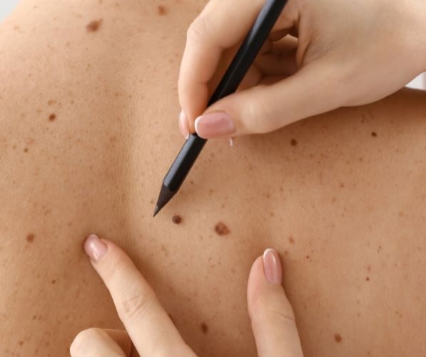 Trattamento estetico con laser per l’eliminazione di neoformazioni cutanee