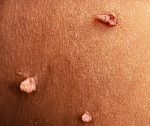 Rimozione fibromi penduli senza bisturi