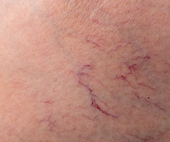 Approfondimento medico sul ruolo del laser Nd:YAG nel trattamento di capillari, angiomi e couperose, con indicazioni e limiti clinici.