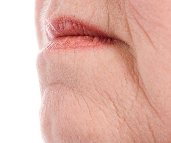 Codice a barre labbra: cosa sono le rughe verticali, cause e prevenzione. Approcci medici possibili, limiti e rischi.