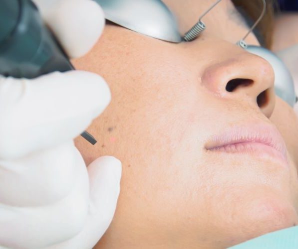 Il laser Nd:YAG è una tecnologia utilizzata in dermatologia per il trattamento di specifiche alterazioni vascolari cutanee, sulla base di un’interazione selettiva tra energia luminosa e strutture vascolari.