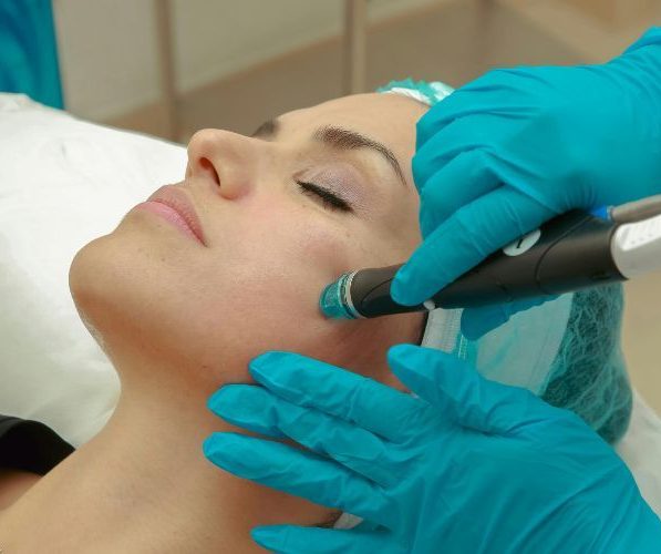 Laser Nd:YAG sul viso: indicazioni, benefici e limiti nel trattamento di capillari, couperose e lesioni vascolari.