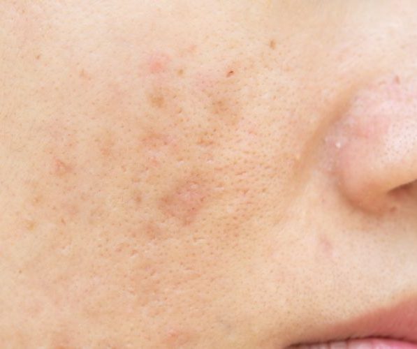 Macchie Cutanee e Laser Q Switched