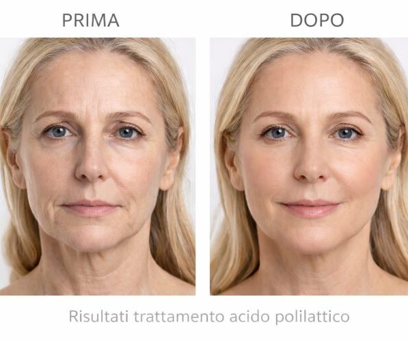 acido polilattico viso