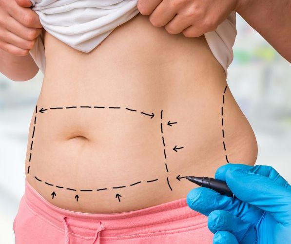 Lipolisi non chirurgica: cos’è, come funziona e quando sceglierla